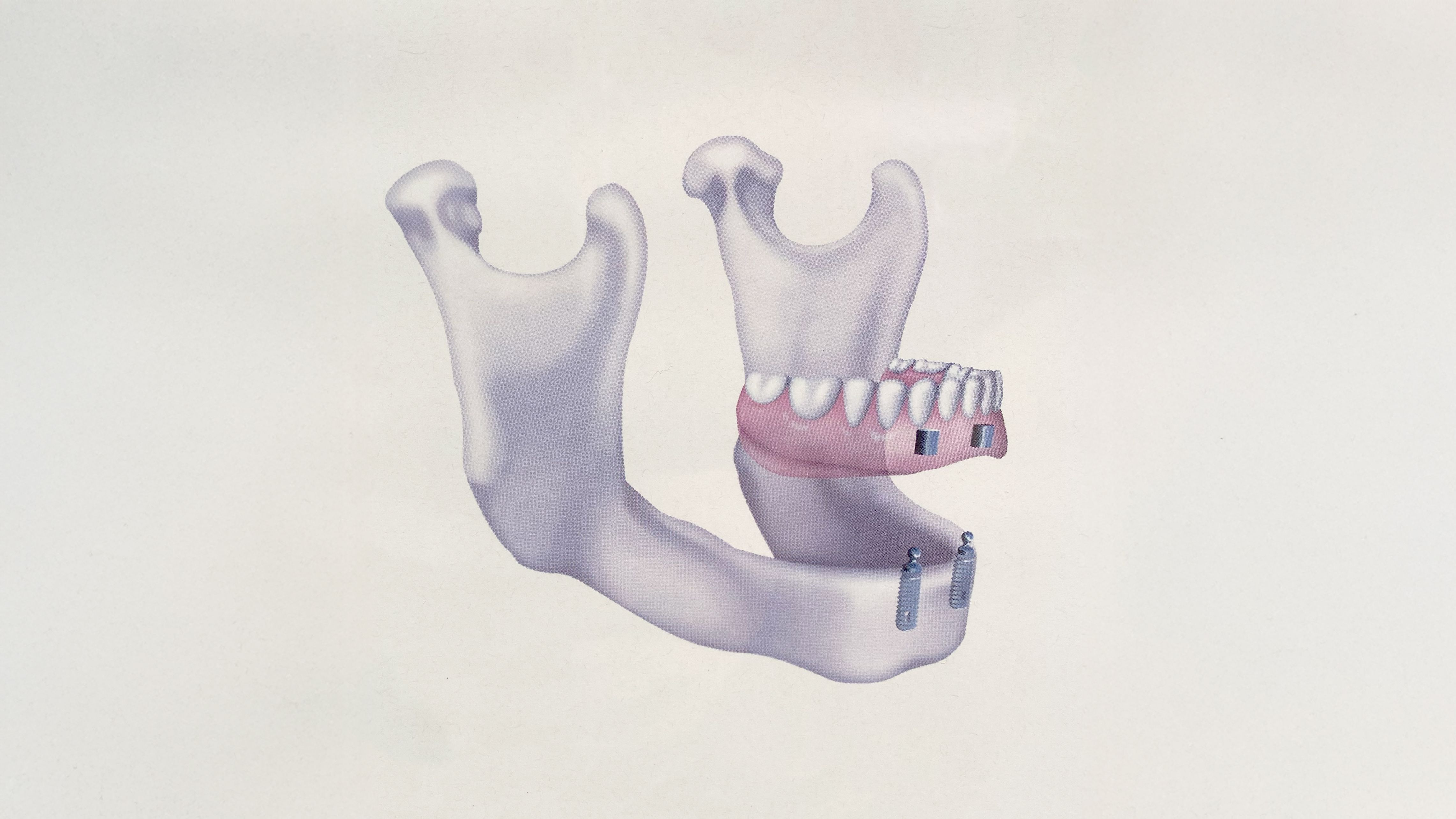 Implantater